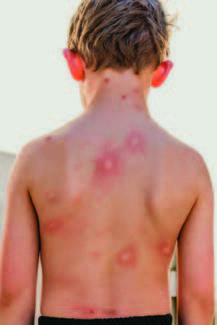 child with mosquito bites