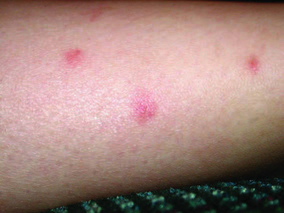 The welts produced from those bites.