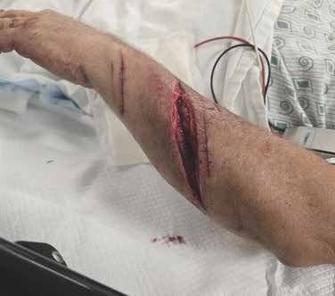 A person with injured hand